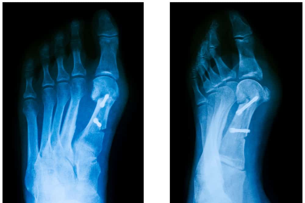Hallux Valugs vs. gesunder Fuß im Röntgen