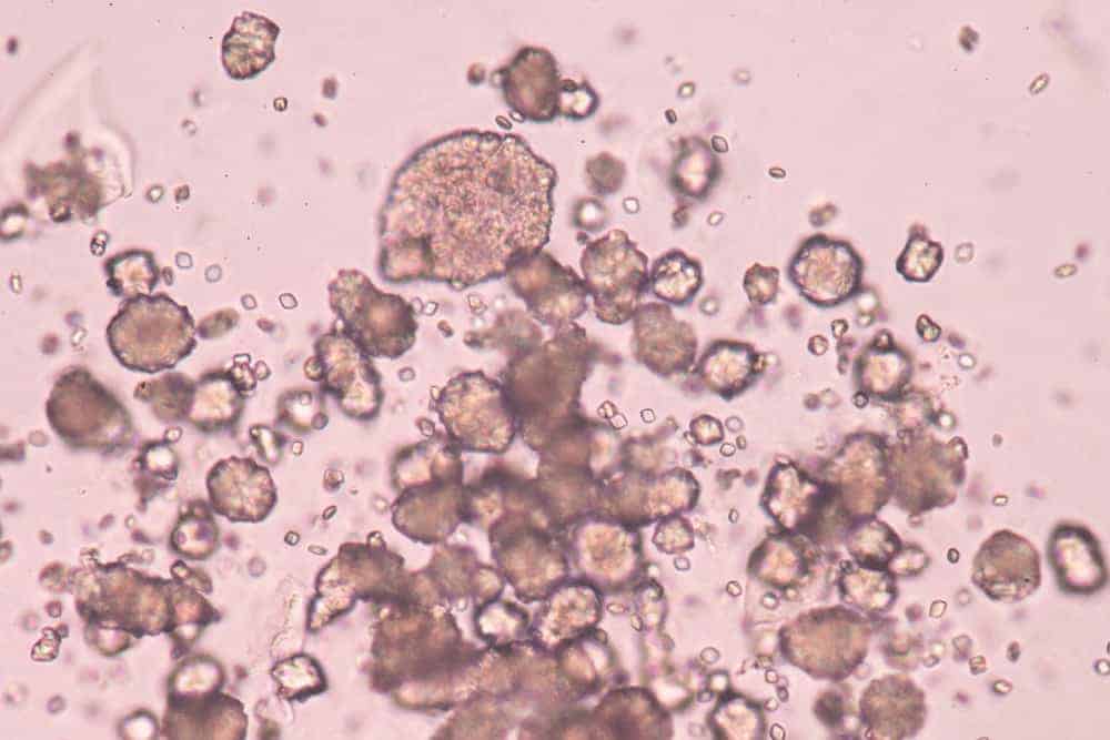 Harnsäurekristalle unter dem Mikroskop