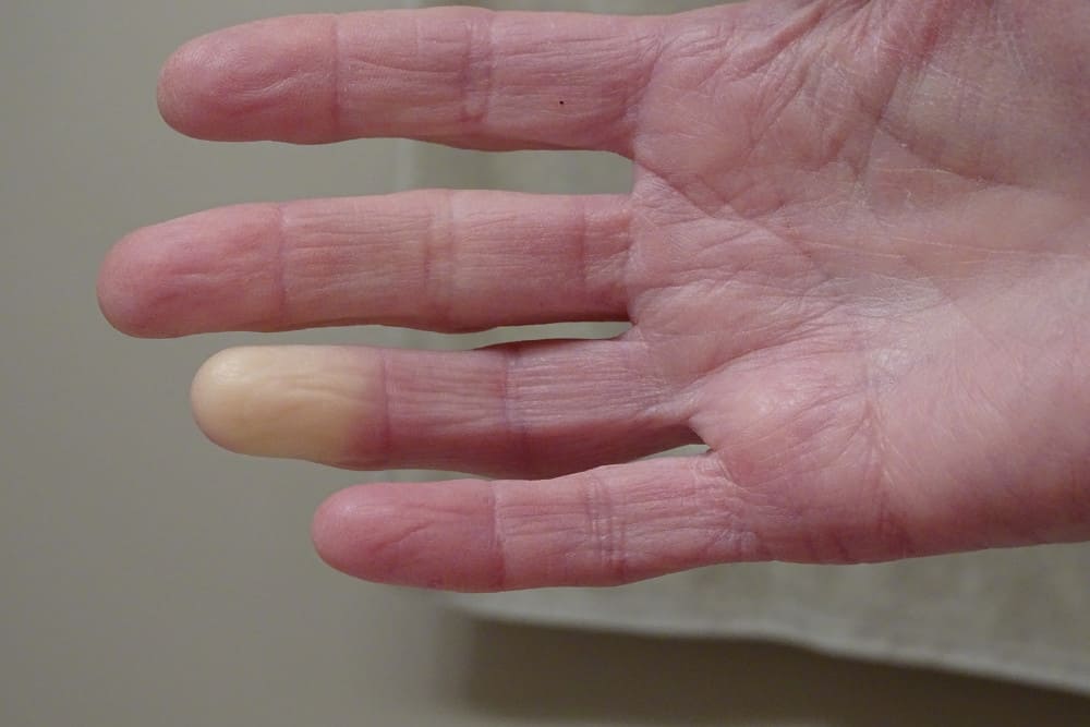Raynaud Syndrom weiß verfärbter Finger