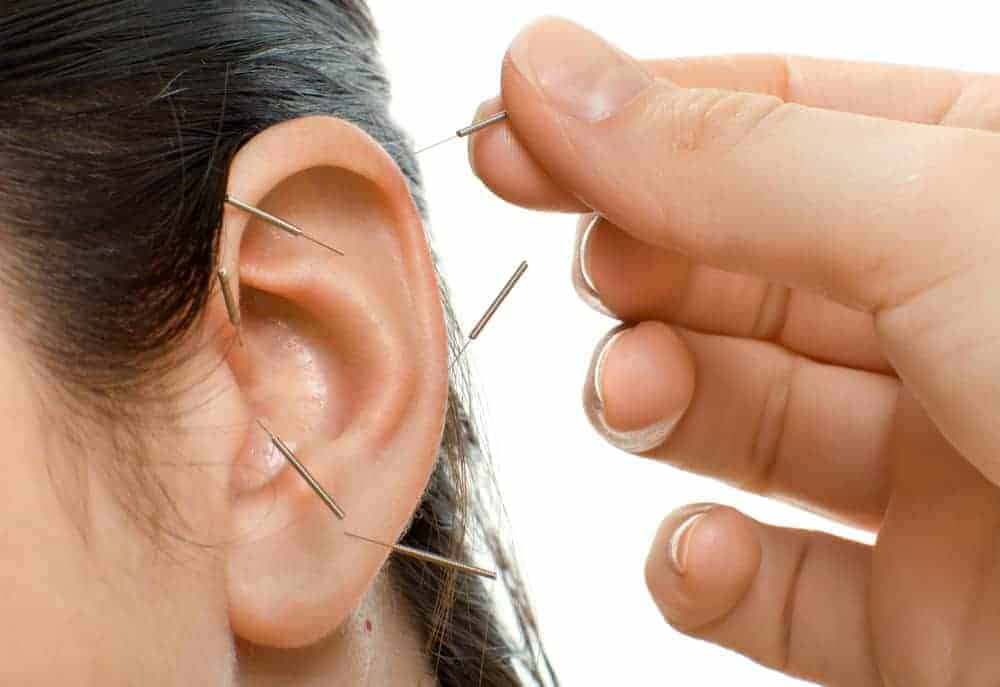 Frauenohr wird mit Akupunktur behandelt
