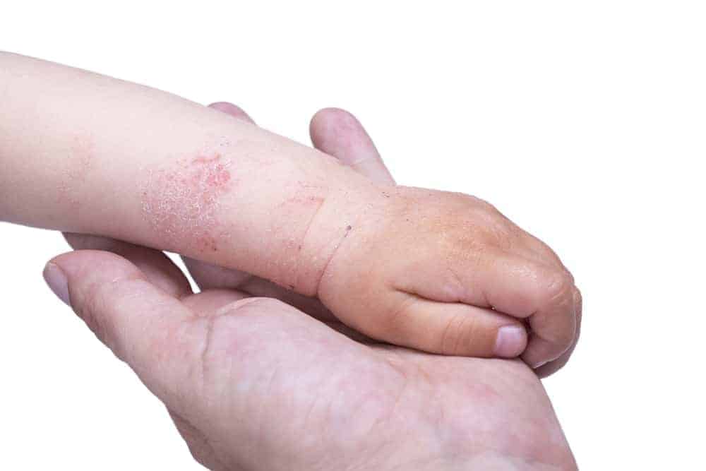 Babyhand mit Hautproblemen hält Hand eines Erwachsenen vor weißem Hintergrund